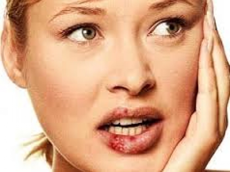 ¿Qué tipos de virus del herpes existen? Clasificación de los tipos de enfermedades virales del herpes labial.