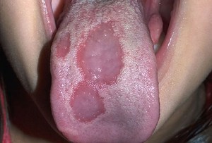 Ulceras en la lengua.