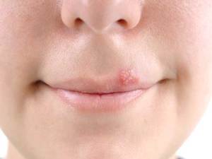 Qué frotis llagas en los labios
